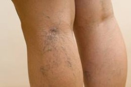 spider veins